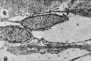 F,42y. | pseudoangiomatous hyperplasia